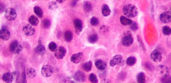 Micrograph of a plasmacytoma, a hematological malignancy