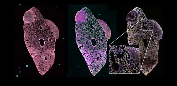 Lung with two metastatic lesions derived from a mouse primary triple-negative breast tumour