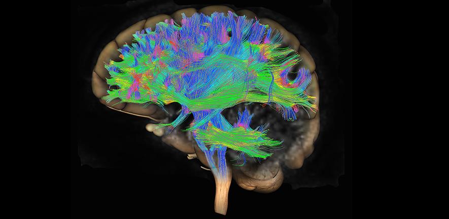 Diffusion tensor imaging (DTI) MRI of the human brain - stock photo