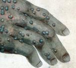 Watercolour of a hand with smallpox by Robert Carswell in 1831