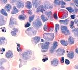 Human cells with acute myelocytic leukemia, shown with an esterase stain at 400x