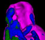 Imaging atherosclerotic calcification or ‘hardening of the arteries’ using positron emission tomography