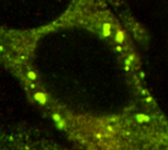 Confocal microscopy showing mutant A1AT as green inclusions within a cell