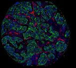 Molecular map of a breast tumour