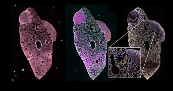 Lung with two metastatic lesions derived from a mouse primary triple-negative breast tumour