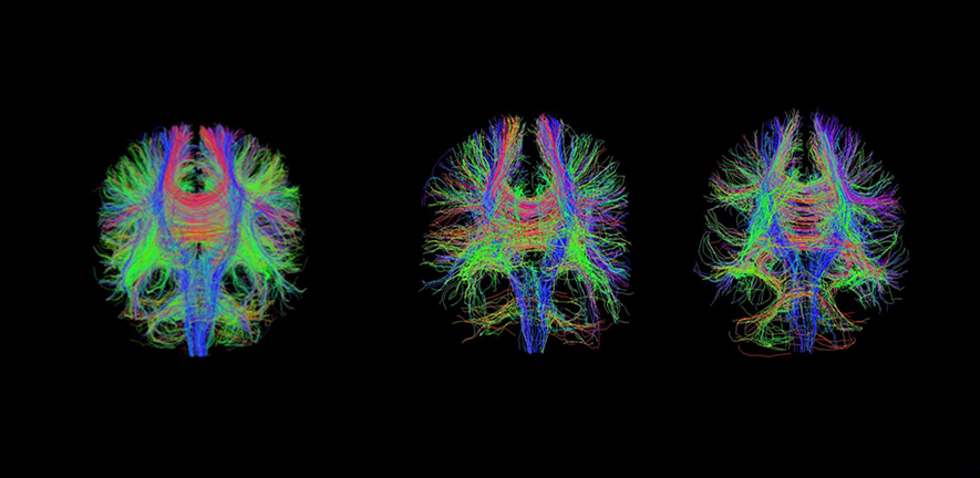 Whole brain diffusion tensor tractography showing healthy patient (left) and patient at two days (centre) and six weeks (right) after severe traumatic brain injury