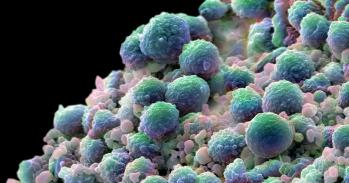 A colour-enhanced image showing a clump of prostate cancer cells