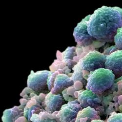 A colour-enhanced image showing a clump of prostate cancer cells